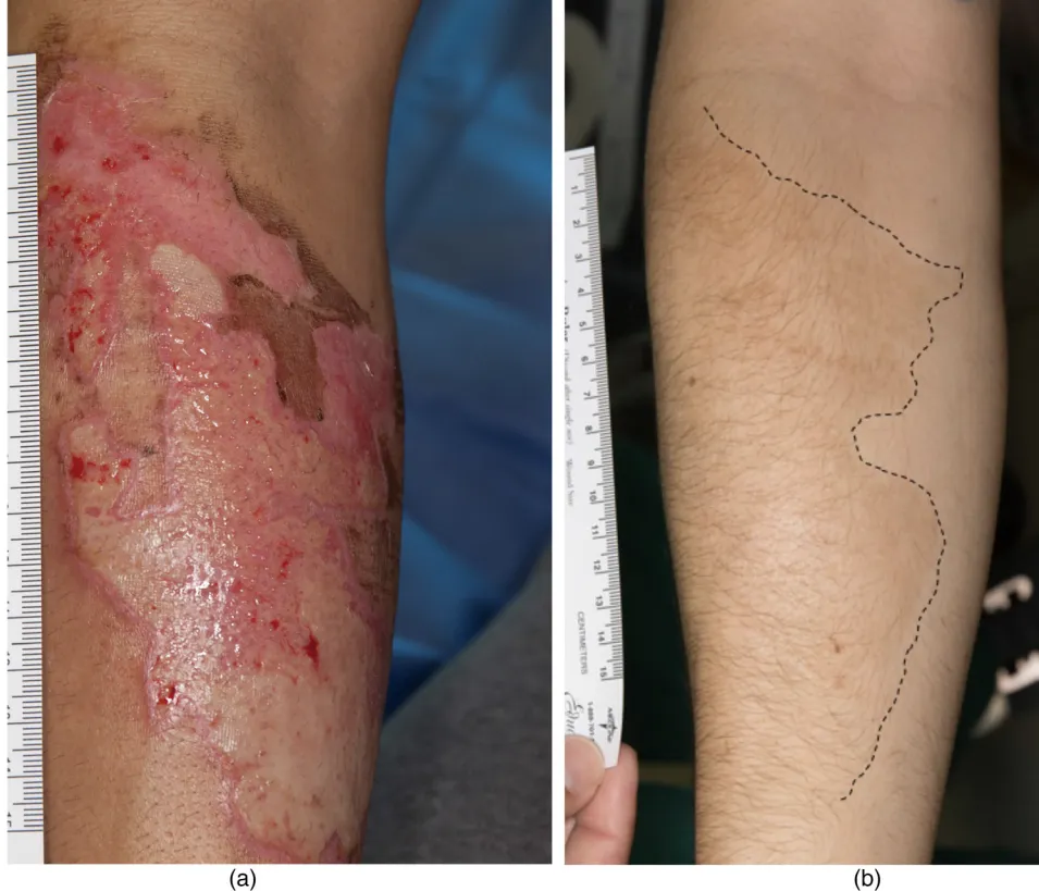 Before and one-year after image showing burn wound healing and new hair growth following BM-MSC stem cell treatment in a male patient with a 29 cm² arm burn