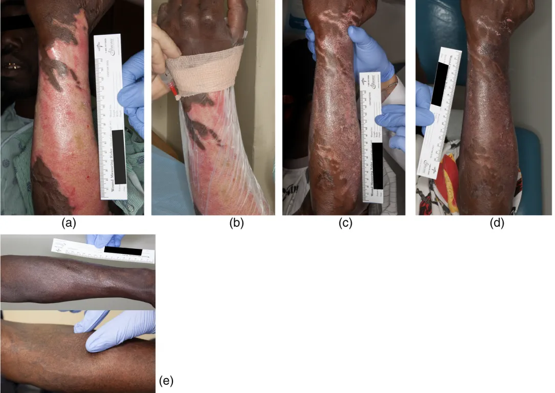Case 6 before and after stem cell treatment for deep second-degree burn on forearm