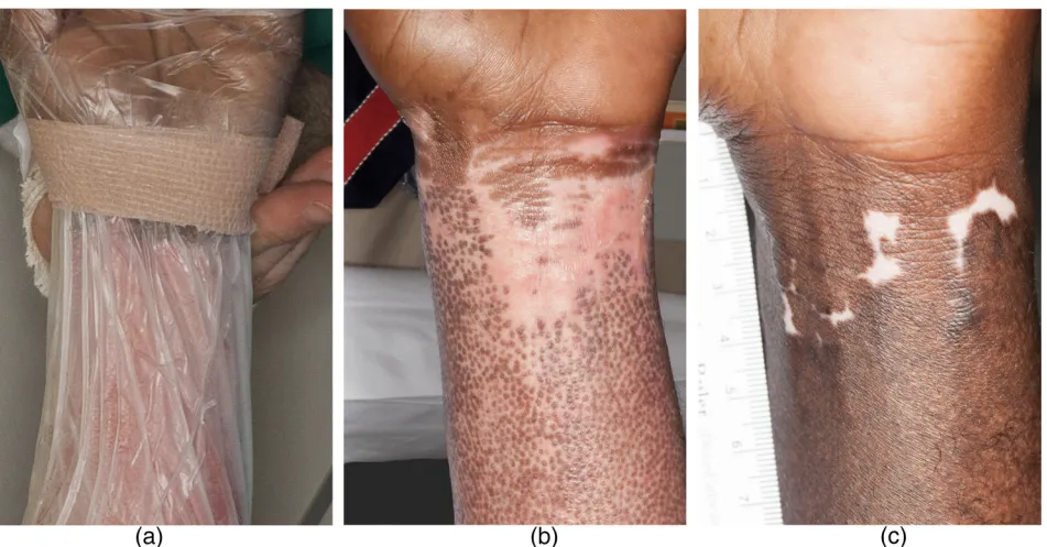 One-year post-treatment image showing repigmentation, smooth skin, and hair regrowth after burn treated with BM-MSC stem cells