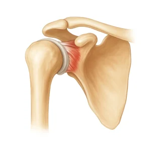 An image of a shoulder joint suffering from tendonitis that could benefit from Stem Cell Therapy