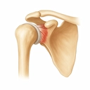 An image of a shoulder joint suffering from tendonitis that could benefit from Stem Cell Therapy